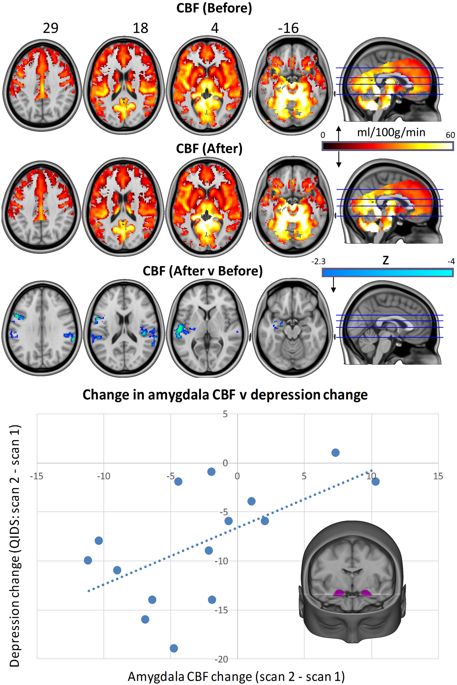 Treating Depression With Psilocybin